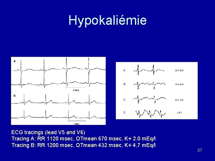 Hypokaliémie ECG tracings (lead V 5 and V 6) Tracing A: RR 1120 msec,