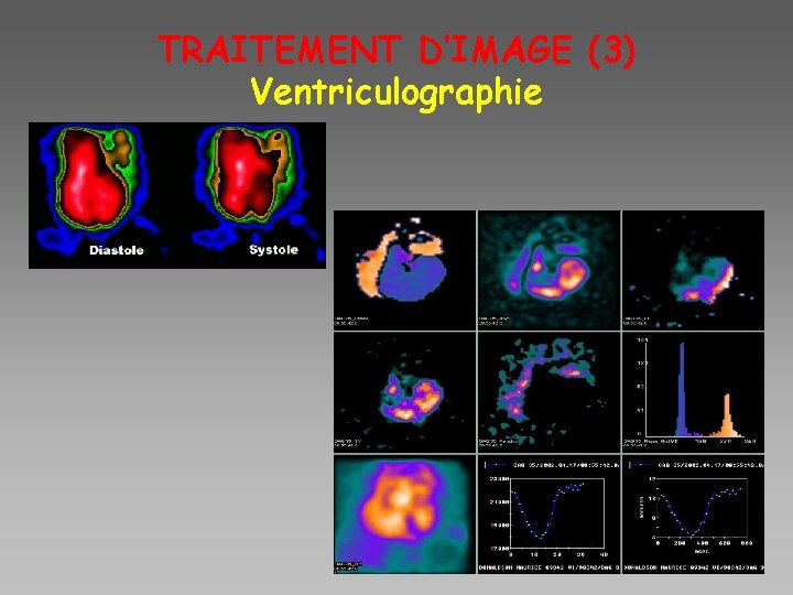 TRAITEMENT D’IMAGE (3) Ventriculographie 