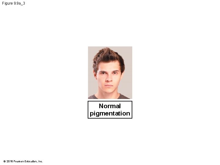 Figure 9. 9 a_3 Normal pigmentation © 2018 Pearson Education, Inc. 