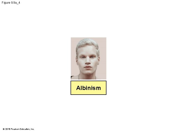 Figure 9. 9 a_4 Albinism © 2018 Pearson Education, Inc. 