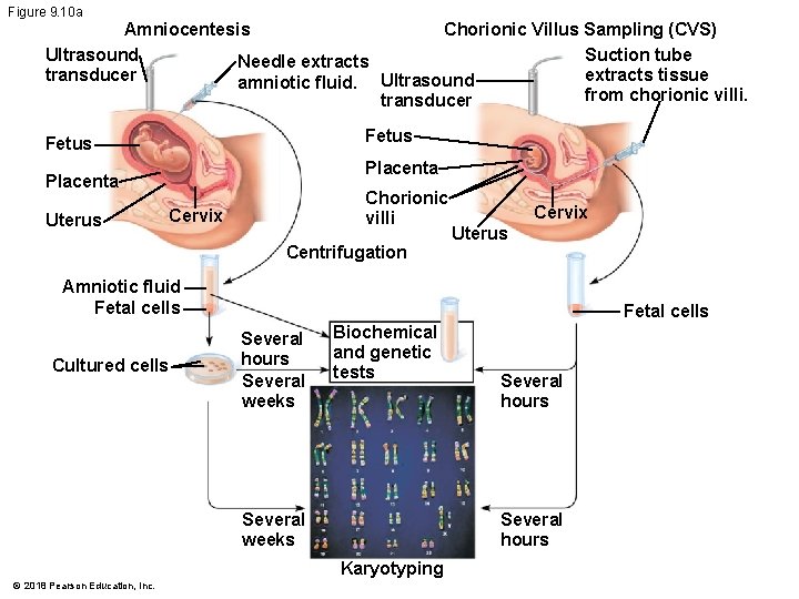Figure 9. 10 a Amniocentesis Chorionic Villus Sampling (CVS) Ultrasound Suction tube Needle extracts