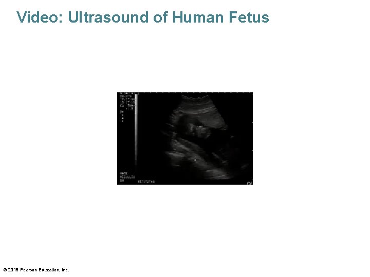 Video: Ultrasound of Human Fetus © 2018 Pearson Education, Inc. 