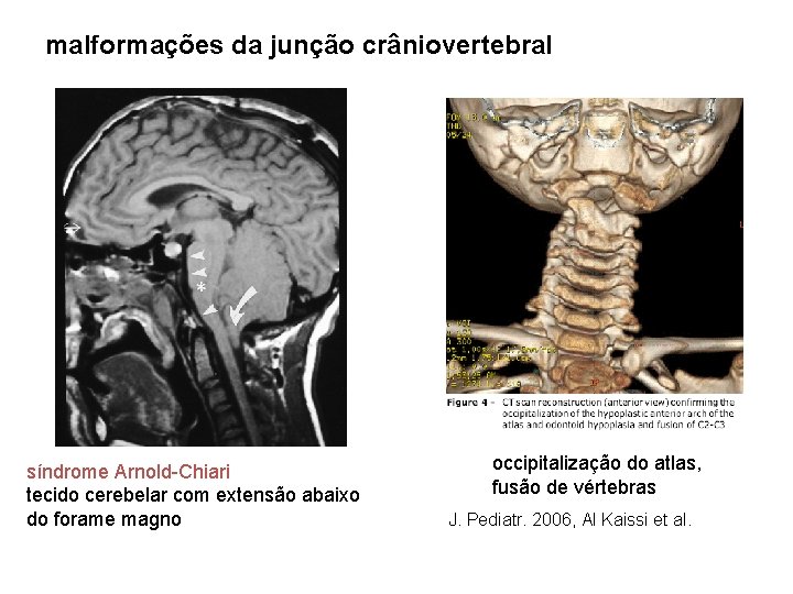 malformações da junção crâniovertebral síndrome Arnold-Chiari tecido cerebelar com extensão abaixo do forame magno