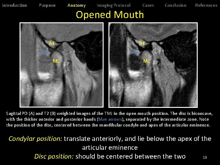 Introduction Purpose AE MC Anatomy Imaging Protocol Cases Opened Mouth Conclusion References AE MC