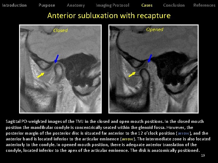 Introduction Purpose Anatomy Imaging Protocol Cases Conclusion References Anterior subluxation with recapture Closed Opened