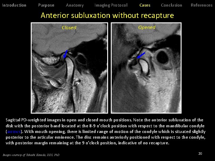 Introduction Purpose Anatomy Imaging Protocol Cases Conclusion References Anterior subluxation without recapture Closed Opened