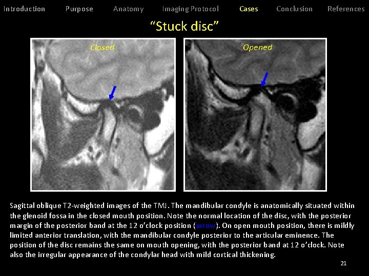 Introduction Purpose Anatomy Imaging Protocol Cases Conclusion References “Stuck disc” Closed Opened Sagittal oblique