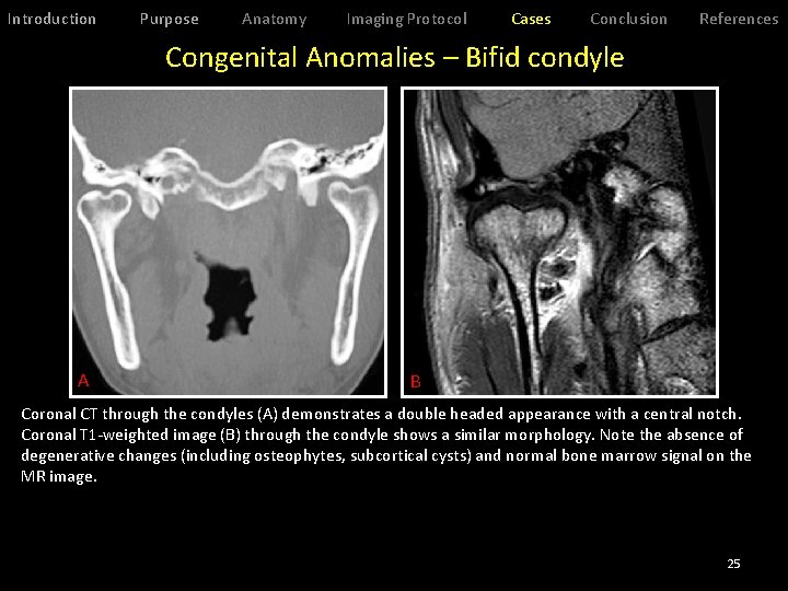 Introduction Purpose Anatomy Imaging Protocol Cases Conclusion References Congenital Anomalies – Bifid condyle A