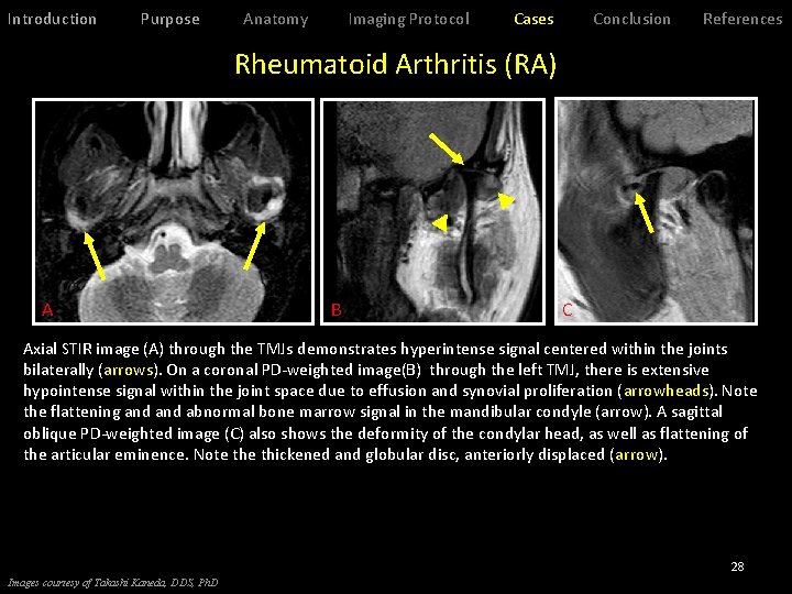 Introduction Purpose Anatomy Imaging Protocol Cases Conclusion References Rheumatoid Arthritis (RA) A B C