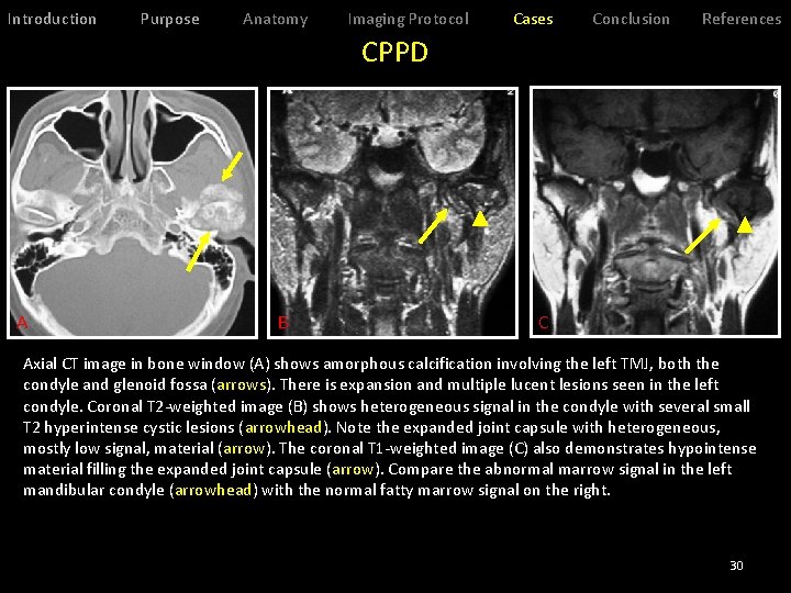 Introduction Purpose Anatomy Imaging Protocol Cases Conclusion References CPPD A B C Axial CT