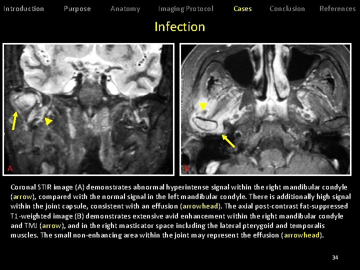 Introduction Purpose Anatomy Imaging Protocol Cases Conclusion References Infection A B Coronal STIR image
