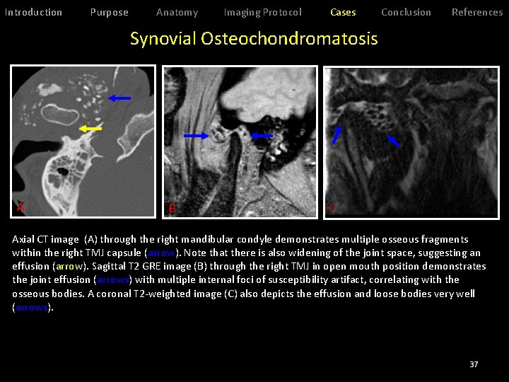 Introduction Purpose Anatomy Imaging Protocol Cases Conclusion References Synovial Osteochondromatosis A B C Axial