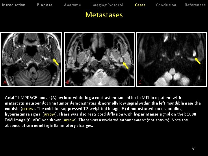 Introduction Purpose Anatomy Imaging Protocol Cases Conclusion References Metastases A B C Axial T