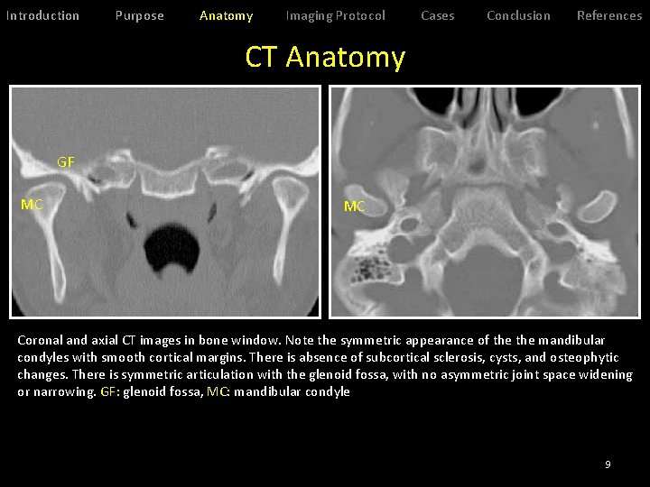 Introduction Purpose Anatomy Imaging Protocol Cases Conclusion References CT Anatomy GF MC MC Coronal