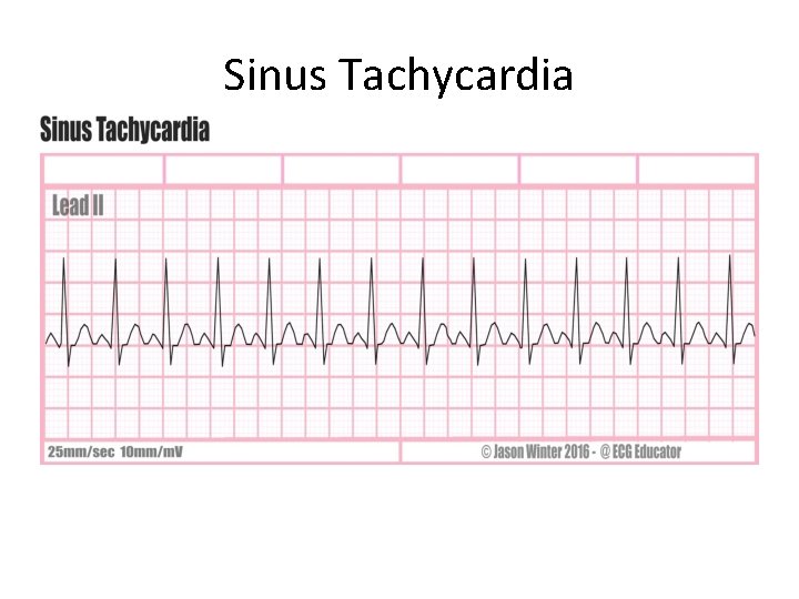 Sinus Tachycardia 