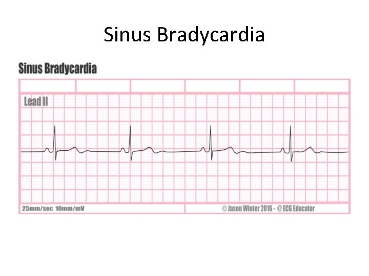 Sinus Bradycardia 