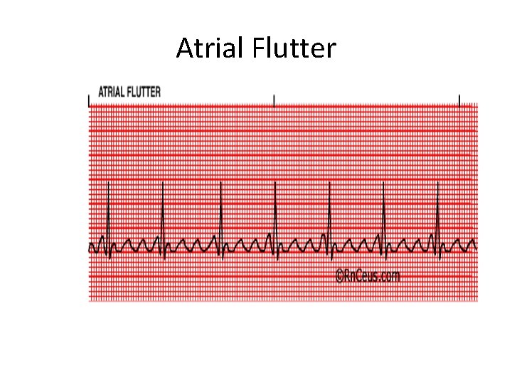 Atrial Flutter 