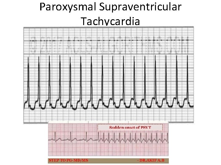 Paroxysmal Supraventricular Tachycardia 