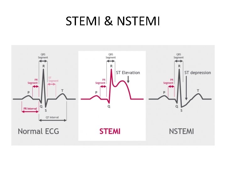 STEMI & NSTEMI 