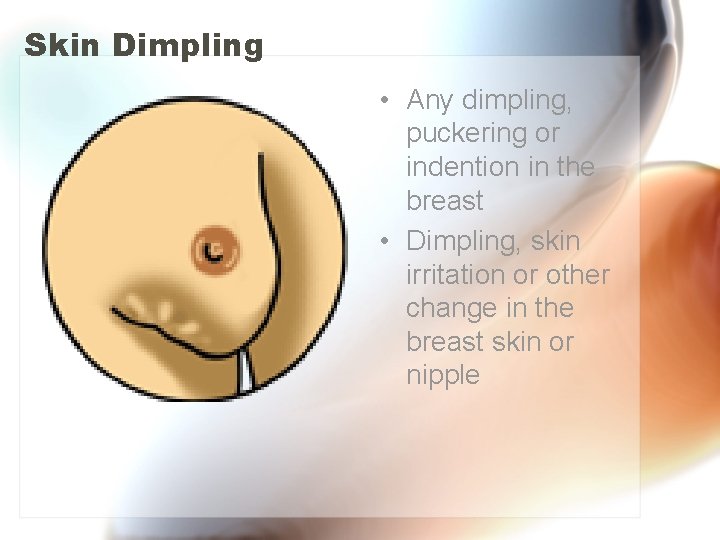 Skin Dimpling • Any dimpling, puckering or indention in the breast • Dimpling, skin