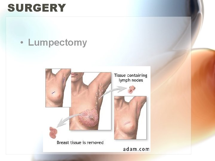 SURGERY • Lumpectomy 