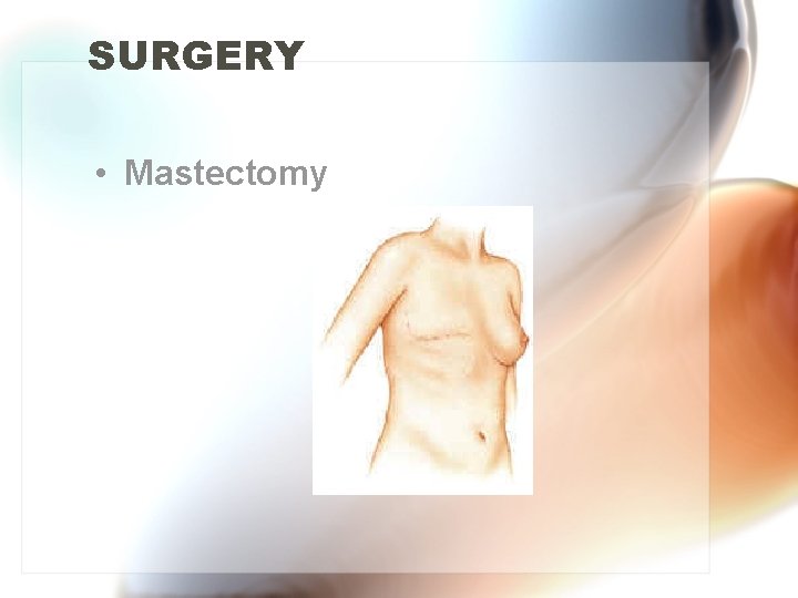 SURGERY • Mastectomy 