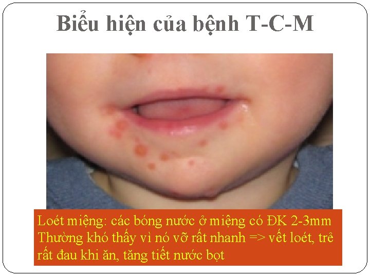 Biểu hiện của bệnh T-C-M Loét miệng: các bóng nước ở miệng có ĐK