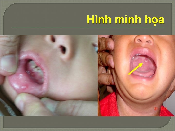 Hình minh họa 