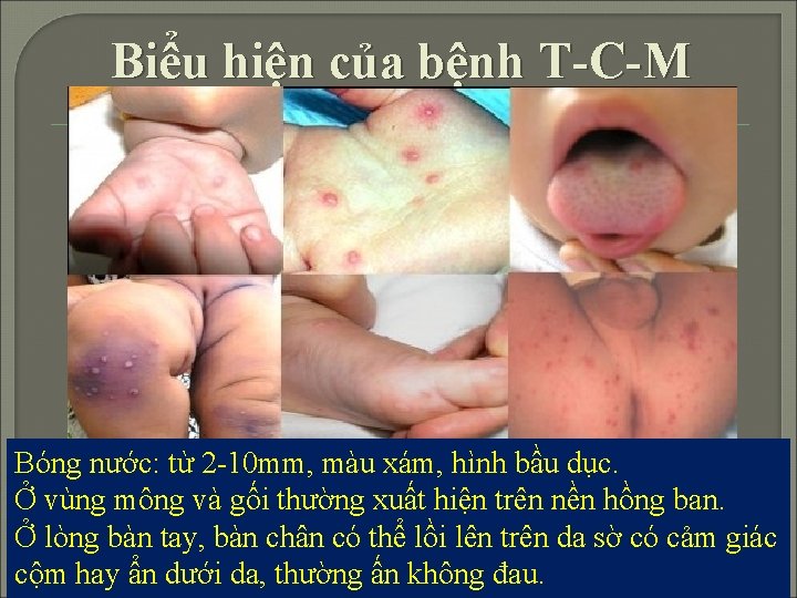 Biểu hiện của bệnh T-C-M Bóng nước: từ 2 -10 mm, màu xám, hình