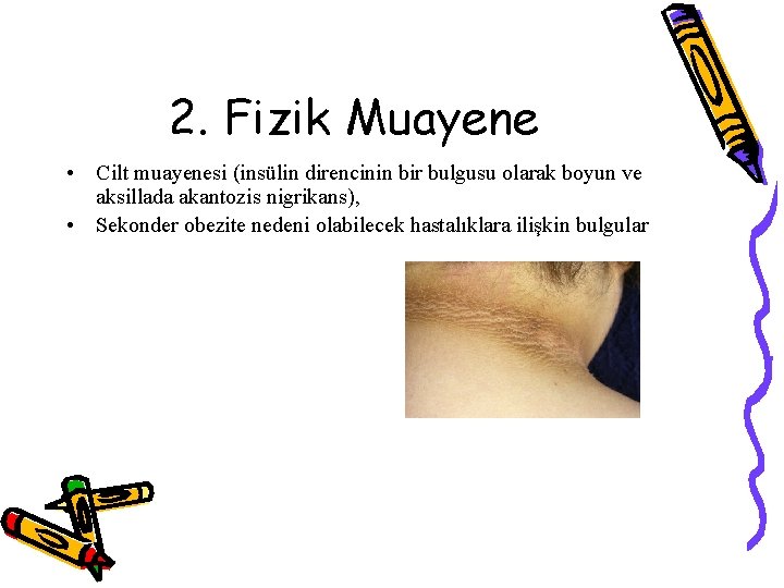 2. Fizik Muayene • Cilt muayenesi (insülin direncinin bir bulgusu olarak boyun ve aksillada
