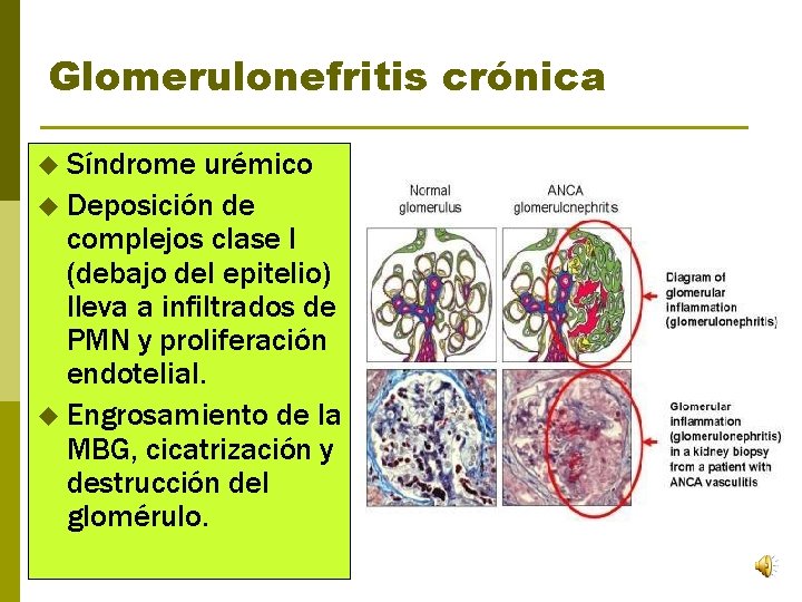 Glomerulonefritis crónica u Síndrome urémico u Deposición de complejos clase I (debajo del epitelio)