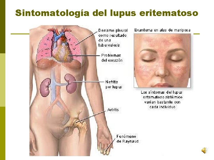 Sintomatología del lupus eritematoso 