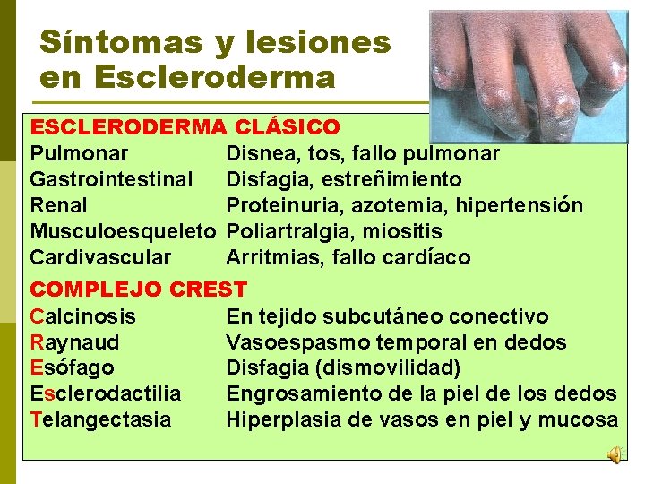 Síntomas y lesiones en Escleroderma ESCLERODERMA CLÁSICO Pulmonar Disnea, tos, fallo pulmonar Gastrointestinal Disfagia,