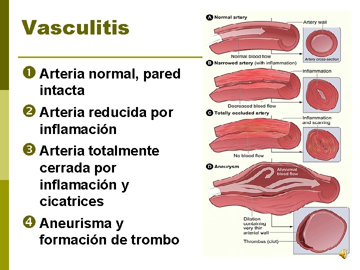 Vasculitis Arteria normal, pared intacta Arteria reducida por inflamación Arteria totalmente cerrada por inflamación