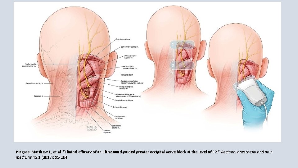 Pingree, Matthew J. , et al. "Clinical efficacy of an ultrasound-guided greater occipital nerve