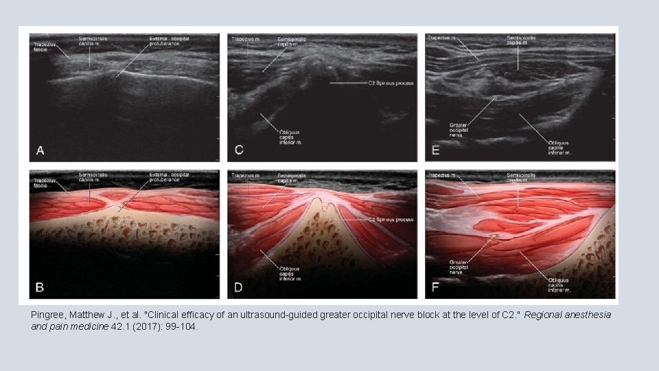 Pingree, Matthew J. , et al. "Clinical efficacy of an ultrasound-guided greater occipital nerve