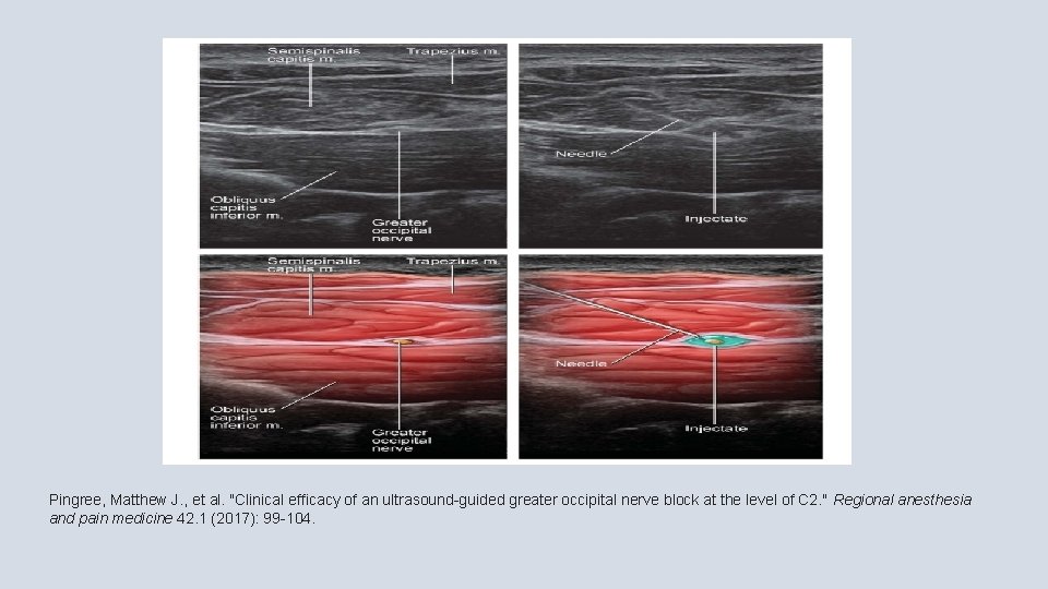 Pingree, Matthew J. , et al. "Clinical efficacy of an ultrasound-guided greater occipital nerve