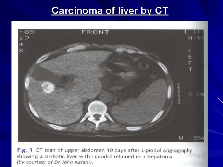 Carcinoma of liver by CT 