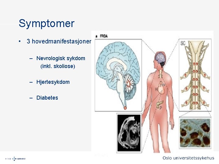 Symptomer • 3 hovedmanifestasjoner – Nevrologisk sykdom (inkl. skoliose) – Hjertesykdom – Diabetes Symptomer • 3 hovedmanifestasjoner – Nevrologisk sykdom (inkl. skoliose) – Hjertesykdom – Diabetes