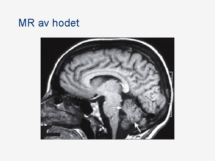 MR av hodet MR av hodet