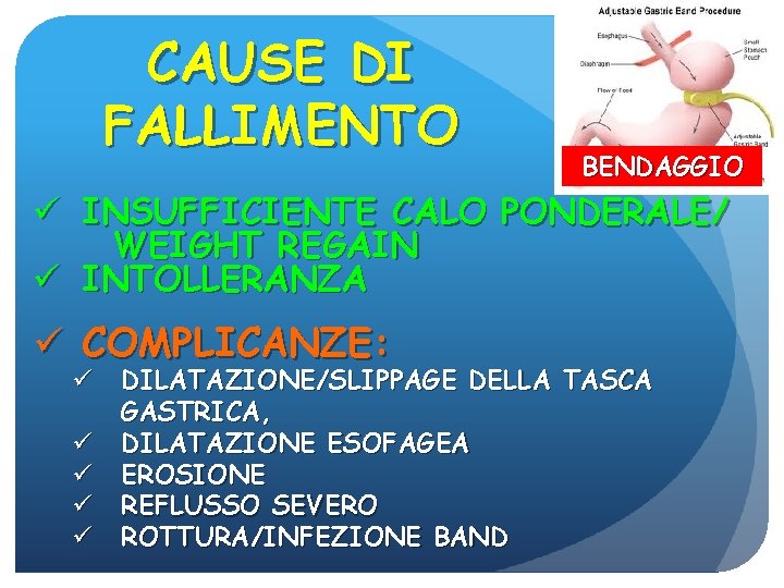 CAUSE DI FALLIMENTO BENDAGGIO ü INSUFFICIENTE CALO PONDERALE/ WEIGHT REGAIN ü INTOLLERANZA ü COMPLICANZE: