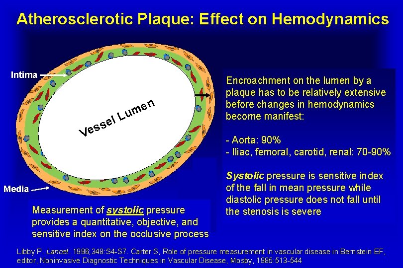 Atherosclerotic Plaque: Effect on Hemodynamics Intima n e m Plaque u L l e