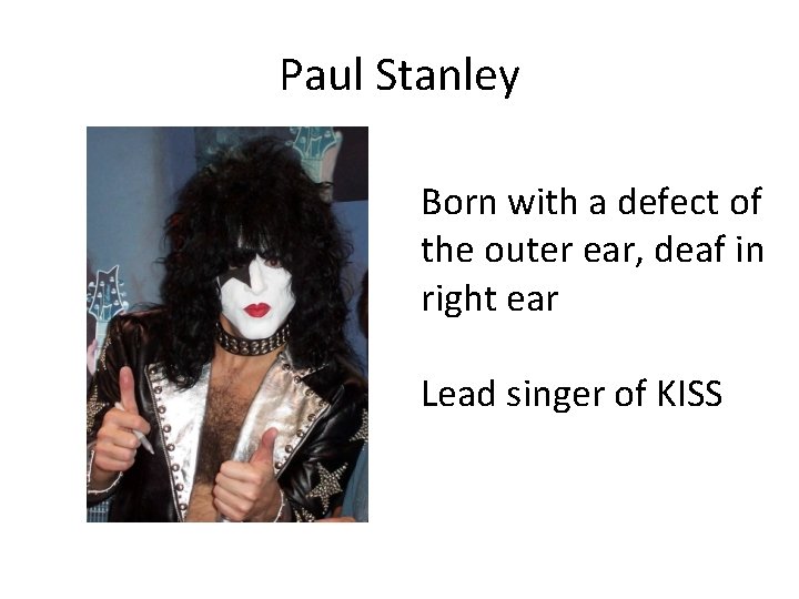 Paul Stanley Born with a defect of the outer ear, deaf in right ear