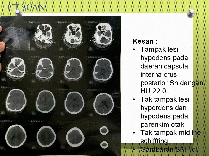 CT SCAN Kesan : • Tampak lesi hypodens pada daerah capsula interna crus posterior