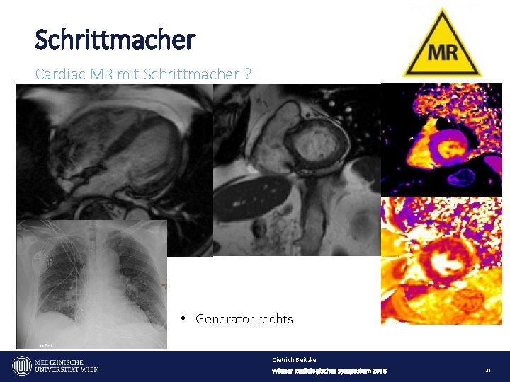 Schrittmacher Cardiac MR mit Schrittmacher ? • Generator rechts Dietrich Beitzke Wiener Radiologisches Symposium