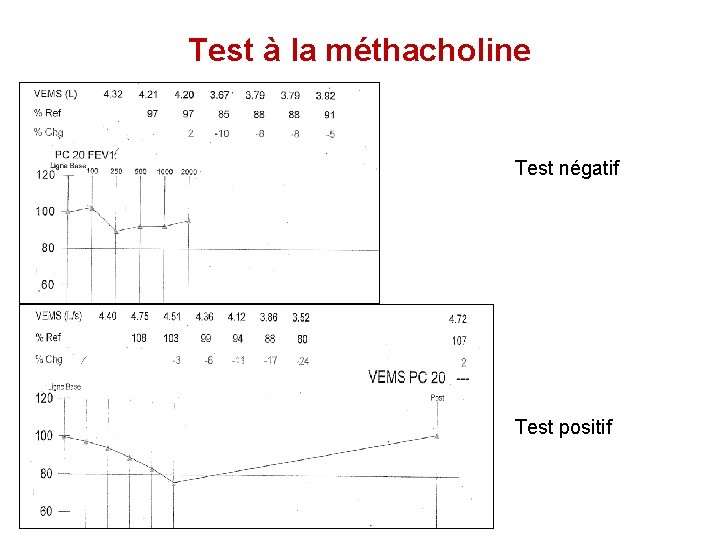 Test à la méthacholine Test négatif Test positif 