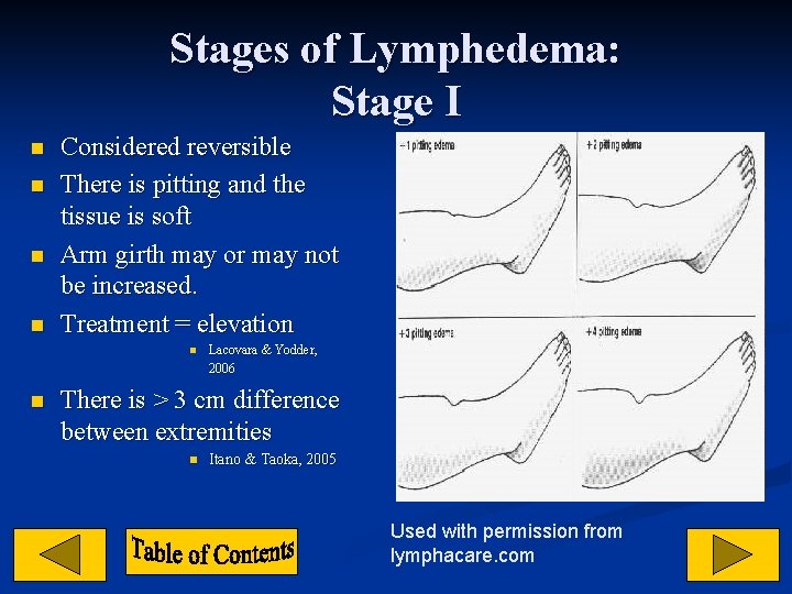 Stages of Lymphedema: Stage I n n Considered reversible There is pitting and the