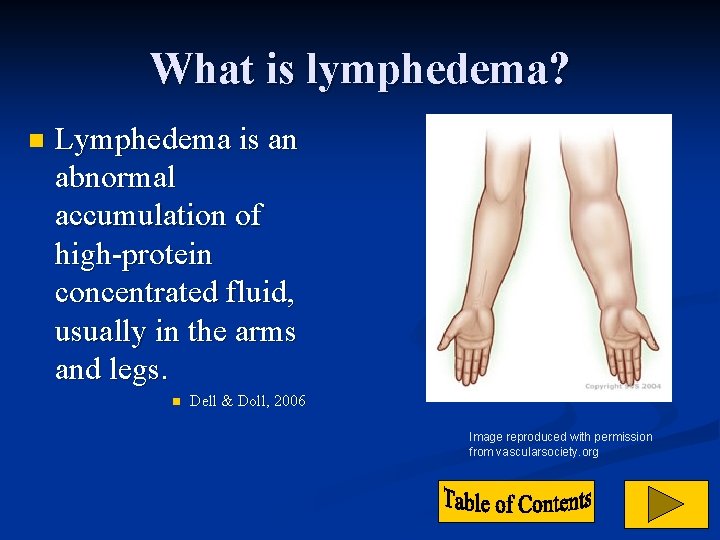 What is lymphedema? n Lymphedema is an abnormal accumulation of high-protein concentrated fluid, usually