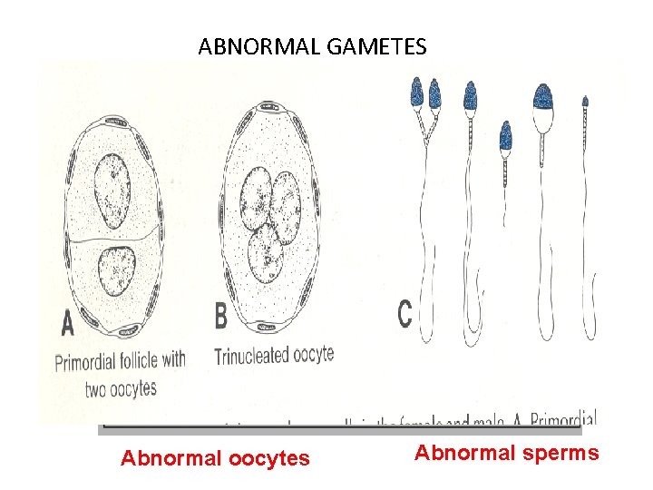 ABNORMAL GAMETES Abnormal oocytes Abnormal sperms 