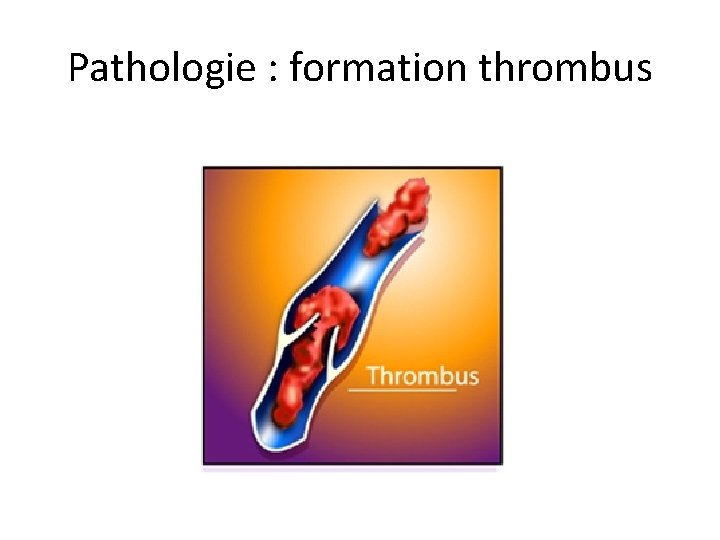 Pathologie : formation thrombus 